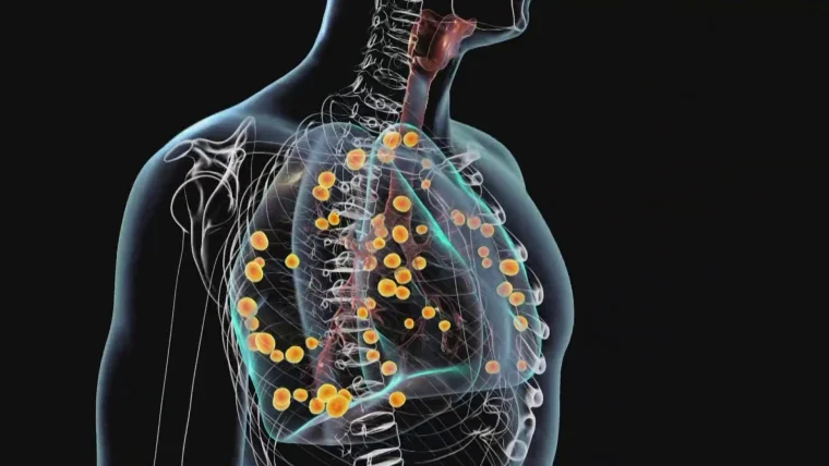Urgent Alert: Mysterious Respiratory Illness Spreads Across Multiple States