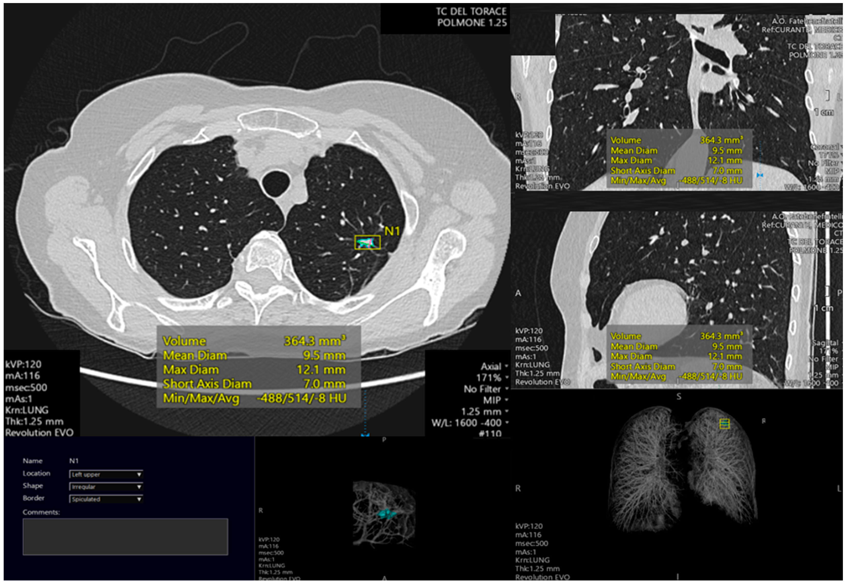 AI-Powered Vision-Language Model Enhances Lung Cancer Detection in CT Scans