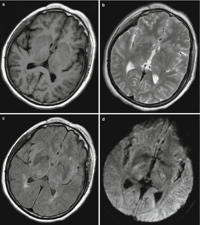 Urgent Global Alert: The Silent Epidemic of Encephalitis You Can’t Afford to Miss
