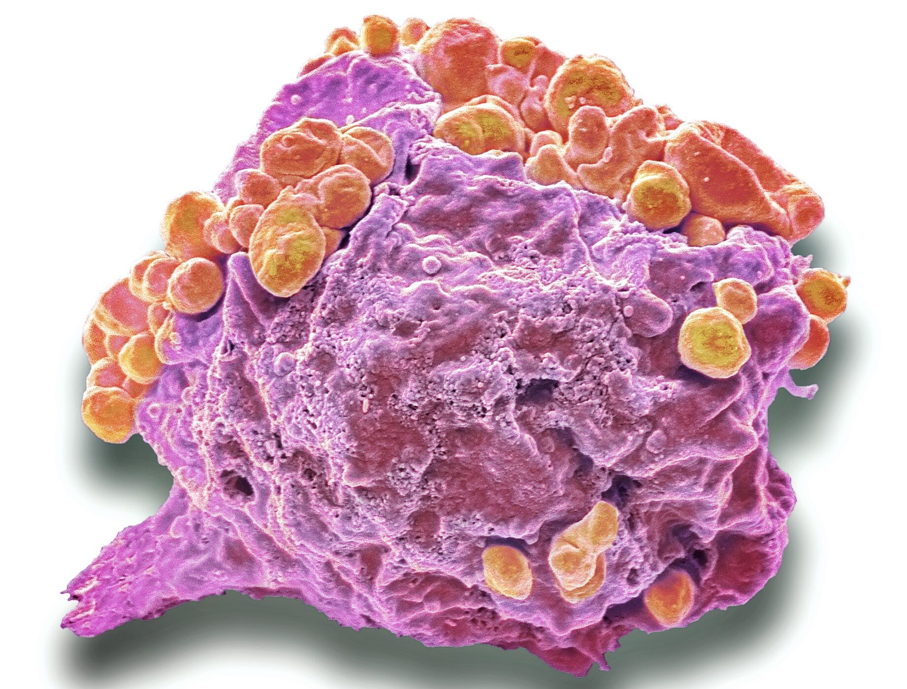 Shocking Study Reveals Autologous Transplant May Be Obsolete for Mantle Cell Lymphoma