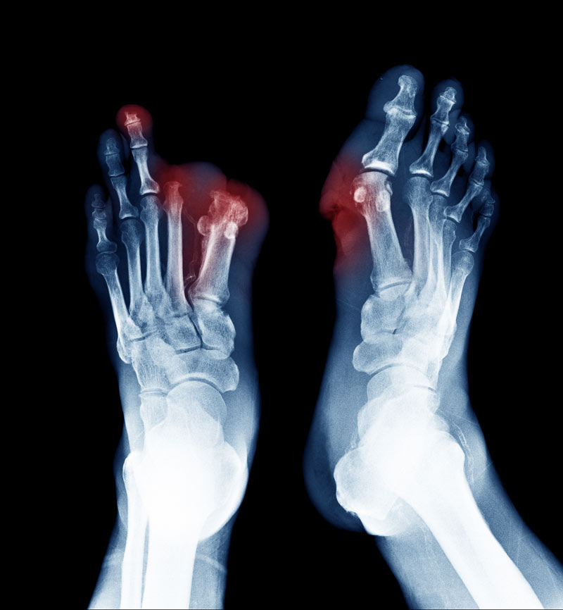Breakthrough: 10-Second Toe Scan Could Save Millions from Silent Amputation Crisis