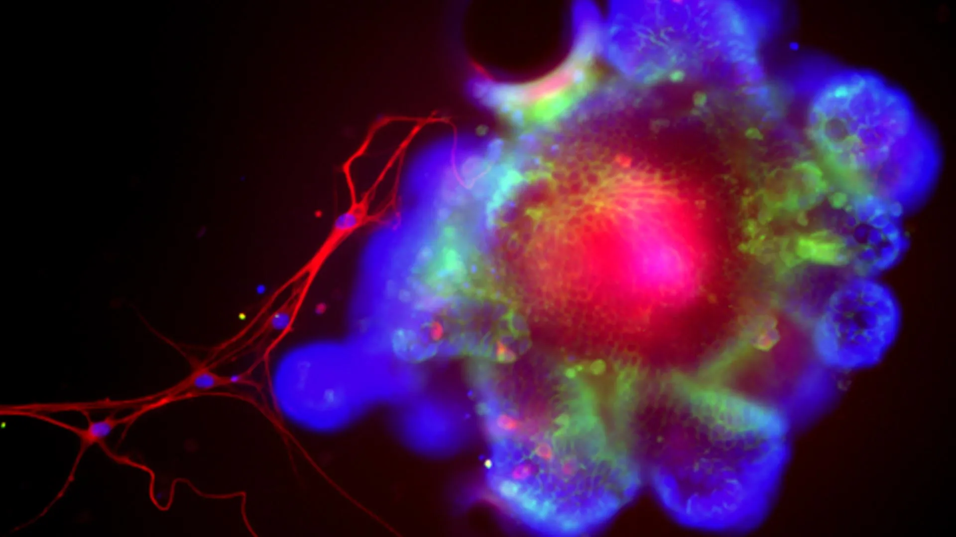 Breakthrough: Hidden Protein Pathway Predicts Liver Disease in Rare Genetic Disorder