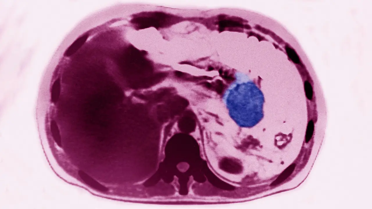 Low risk pancreatic cysts linked to sharply higher cancer risk, study finds
