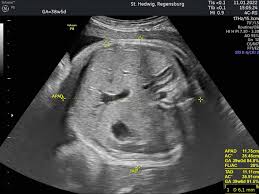 Ultrasound Measurement of Fetal Abdominal Fat May Improve Birth Weight Prediction in Diabetic Pregnancies