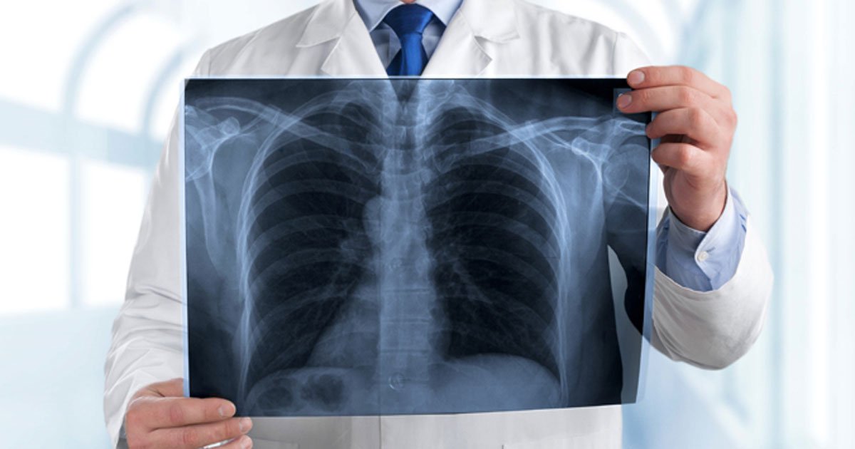 Cryoprobe Technology Marks Major Advance in Lung Biopsy Accuracy, Study Finds