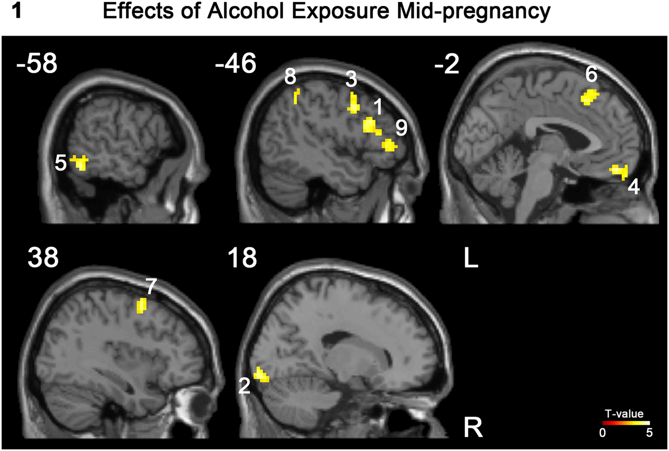 Neural Reward Processing May Hold Key to Alcohol Use Disorder Transmission in Families