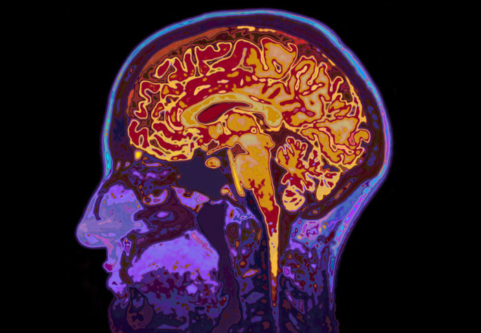 Diabetes and Dementia: The Hidden Links Reshaping Brain Health