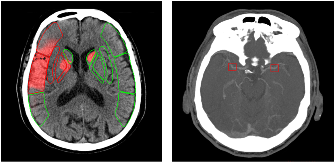 Breakthrough in Stroke Diagnosis: Lightweight AI Model Enhances Accuracy and Transparency in CT Imaging
